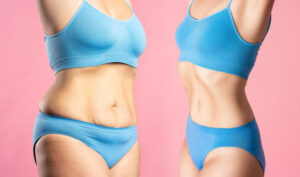 Combining Liposuction with a Healthy Lifestyle