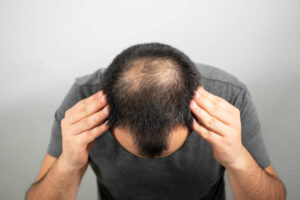 hair transplant in Dubai