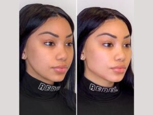 Timeless Beauty Awaits with Thread Lift by Best Doctors in Dubai Experts