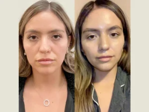 Rejuvenate Your Neck and Jawline with Thread Lift Treatment in Dubai