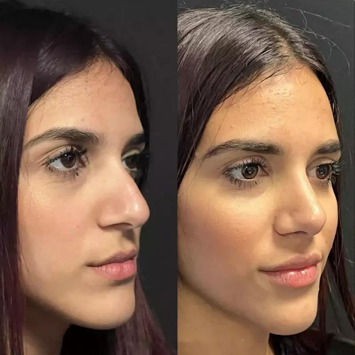 nose surgery in dubai