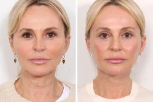 Smooth, Tightened Skin with Thread Lift at the Best Aesthetic Clinics in Dubai