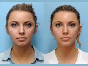 Smooth Wrinkles and Fine Lines Instantly Using Thread Lift Treatment in Dubai