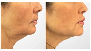 Target Aging Concerns Effectively Using An Advanced Thread Lift in Dubai