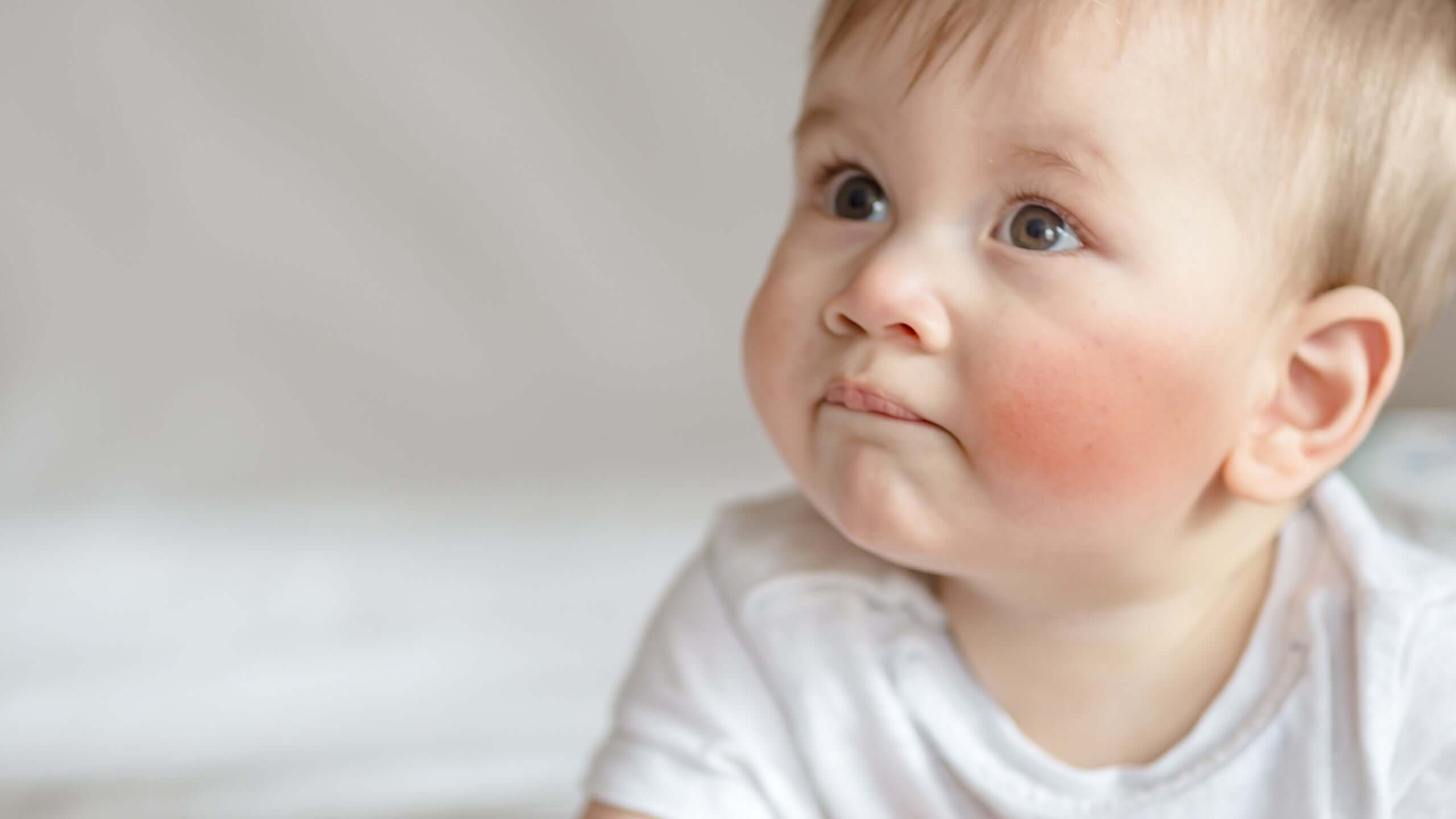 baby acne and eczema