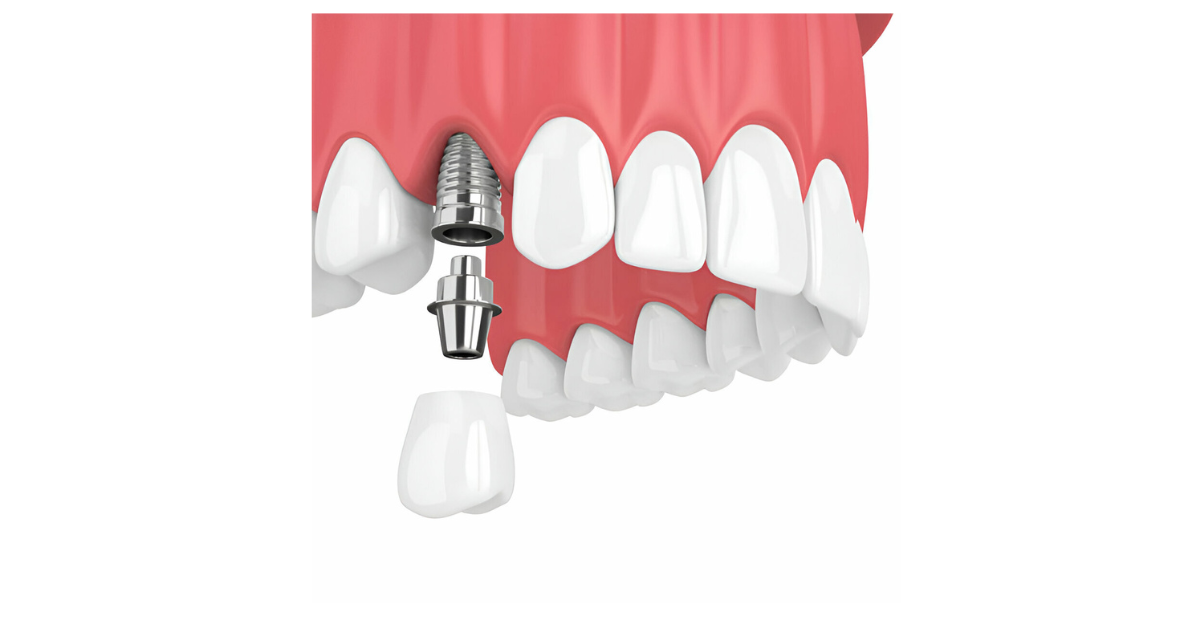 dental Implant Aberdeen