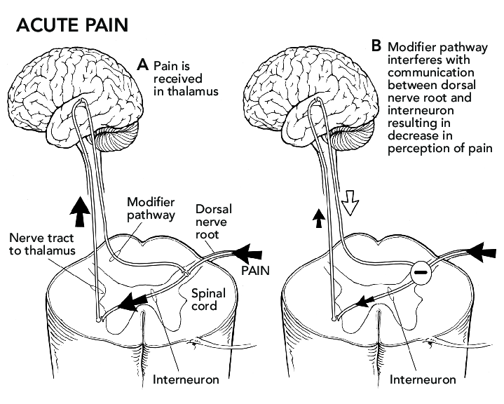 acute-pain