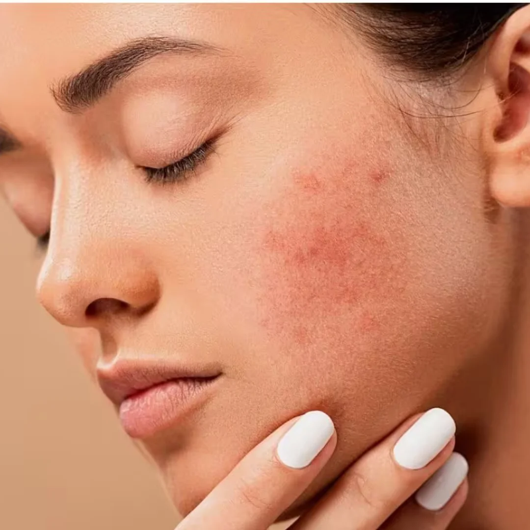 Why You Get Winter Rash and How to Treat Them