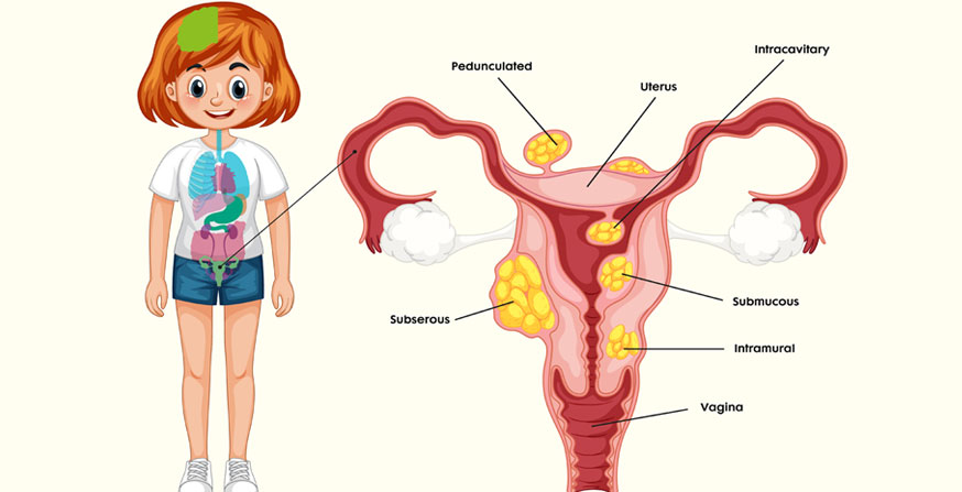 Uterine Fibroids Treatment