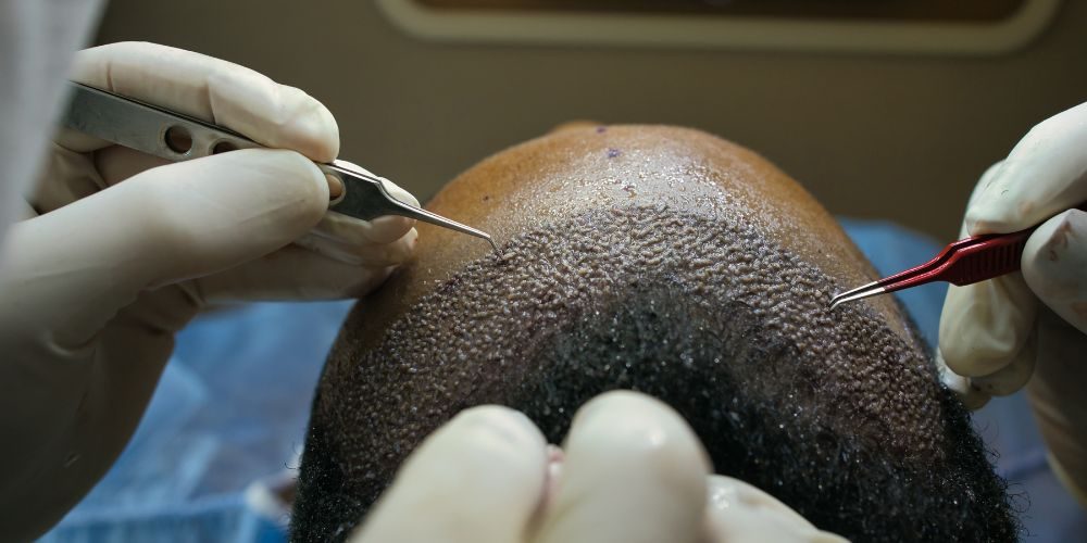 hair transplant in Lahore