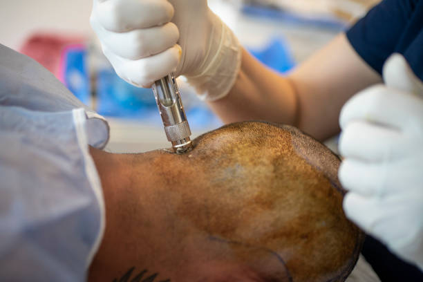 Hair transplant in Abu Dhabi