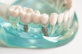 Discover How Dental Implants Change Lives