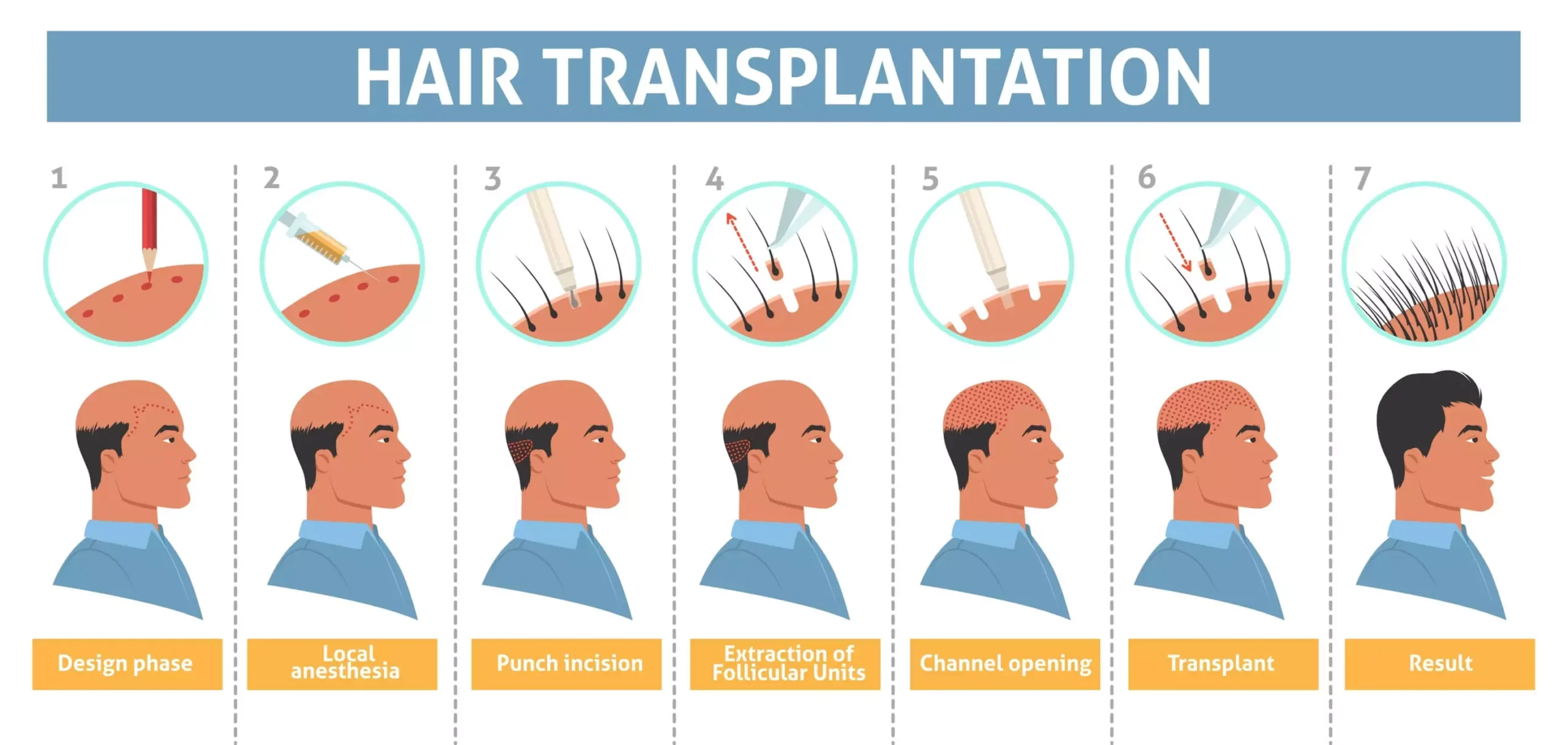 hair transplant birmingham uk