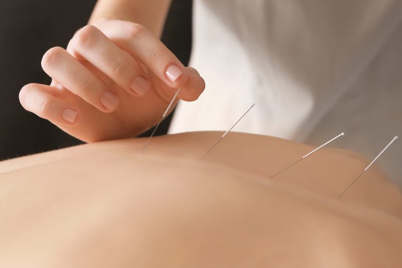 Chinese Acupuncture