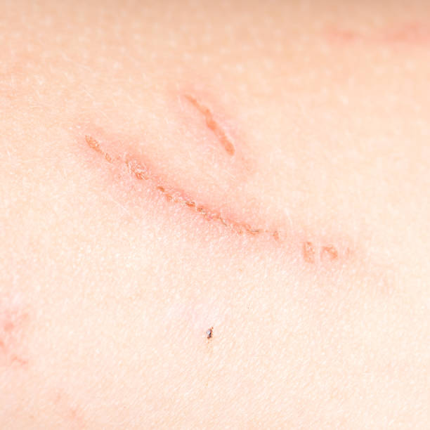 Surgical Scar Revision: A New Beginning for Your Skin