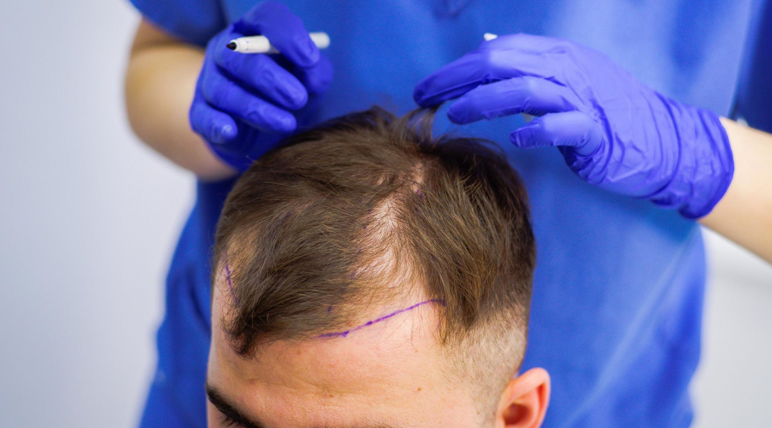 hair transplant