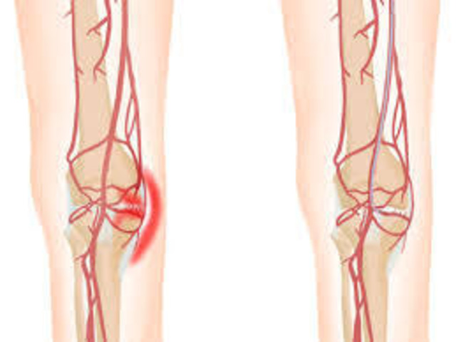 Genicular Artery Embolization