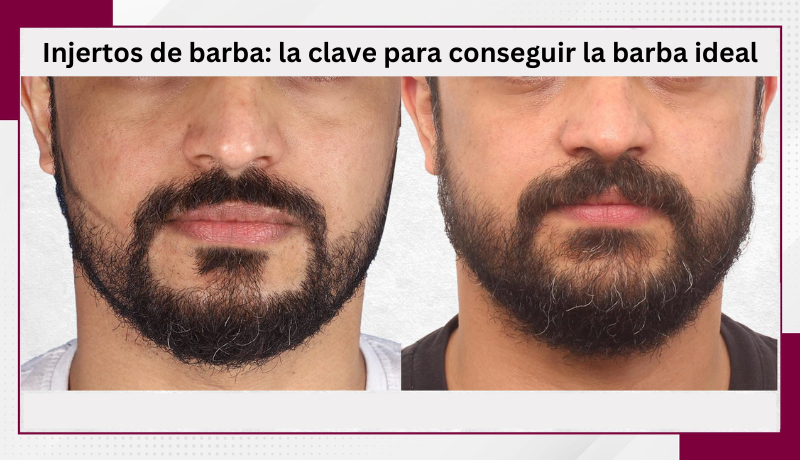 injertos de barba