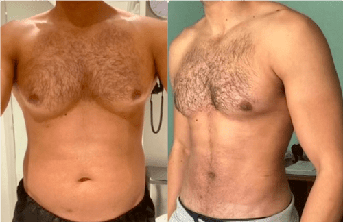 Gynecomastia Surgeons in Dubai