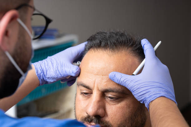 زراعة الشعر بتقنية FUE في أبوظبي