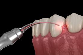 laser dentistry for kids in Billings, MT