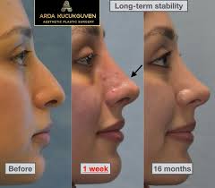 rhinoplasty in Lahore