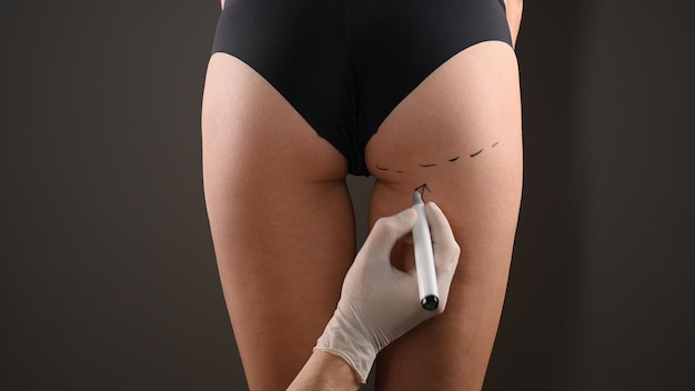 Is Brazilian Butt Lift Surgery Popular?