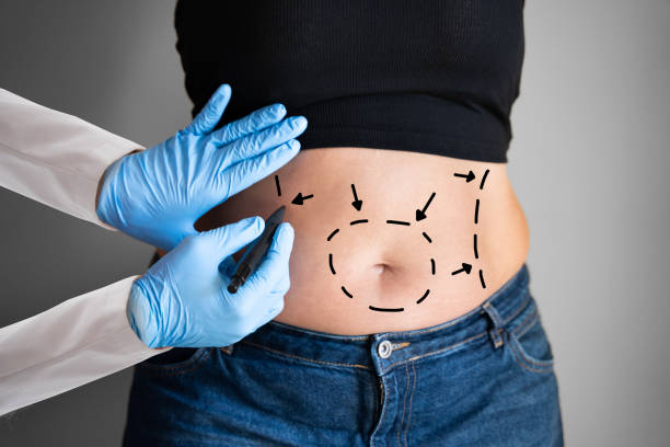 Is Tummy Tuck Surgery Safe for Everyone?