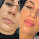 Best Plastic Surgeons in dubai: Understanding the Risks of Dermal Fillers