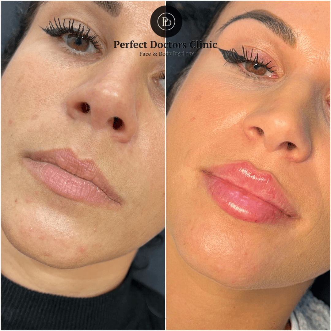 Dermal Fillers