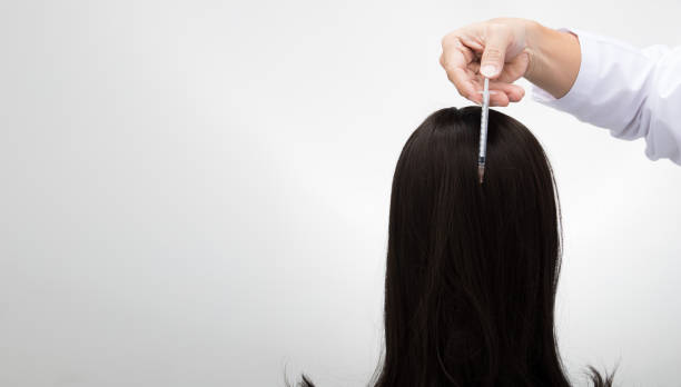 What Makes PRP Hair Treatment a Good Choice?