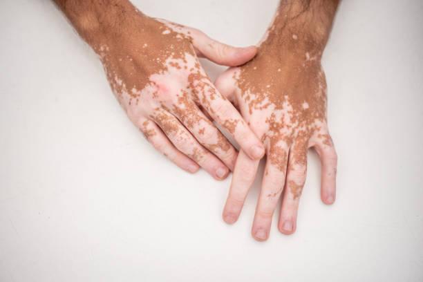 What Makes Vitiligo Treatment Unique?