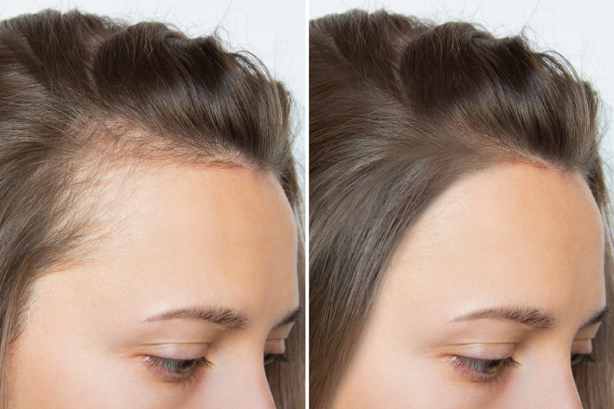 Hair Loss Treatment in Dubai