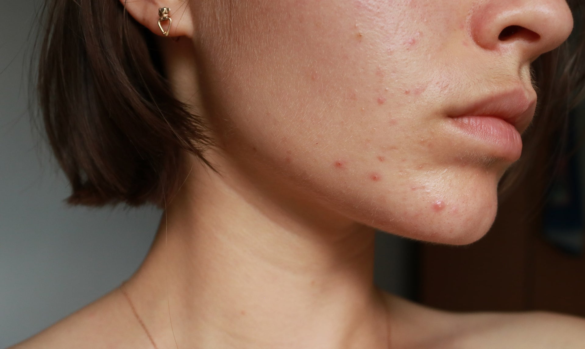 Acne Treatment Dubai