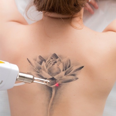 Picosure Tattoo Removal in Dubai