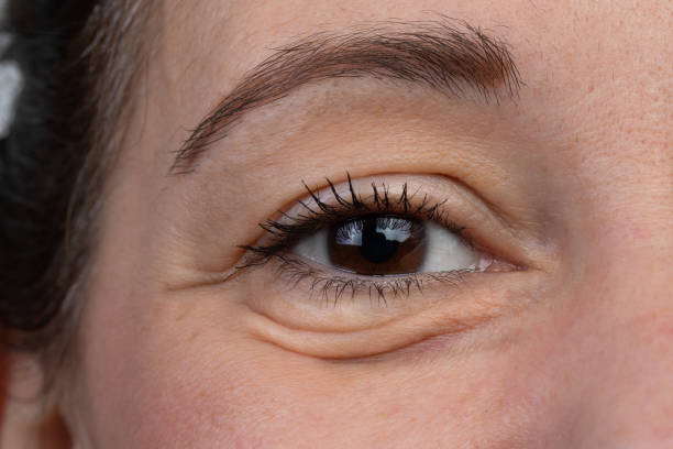 What to Expect from Under Eye Fillers?