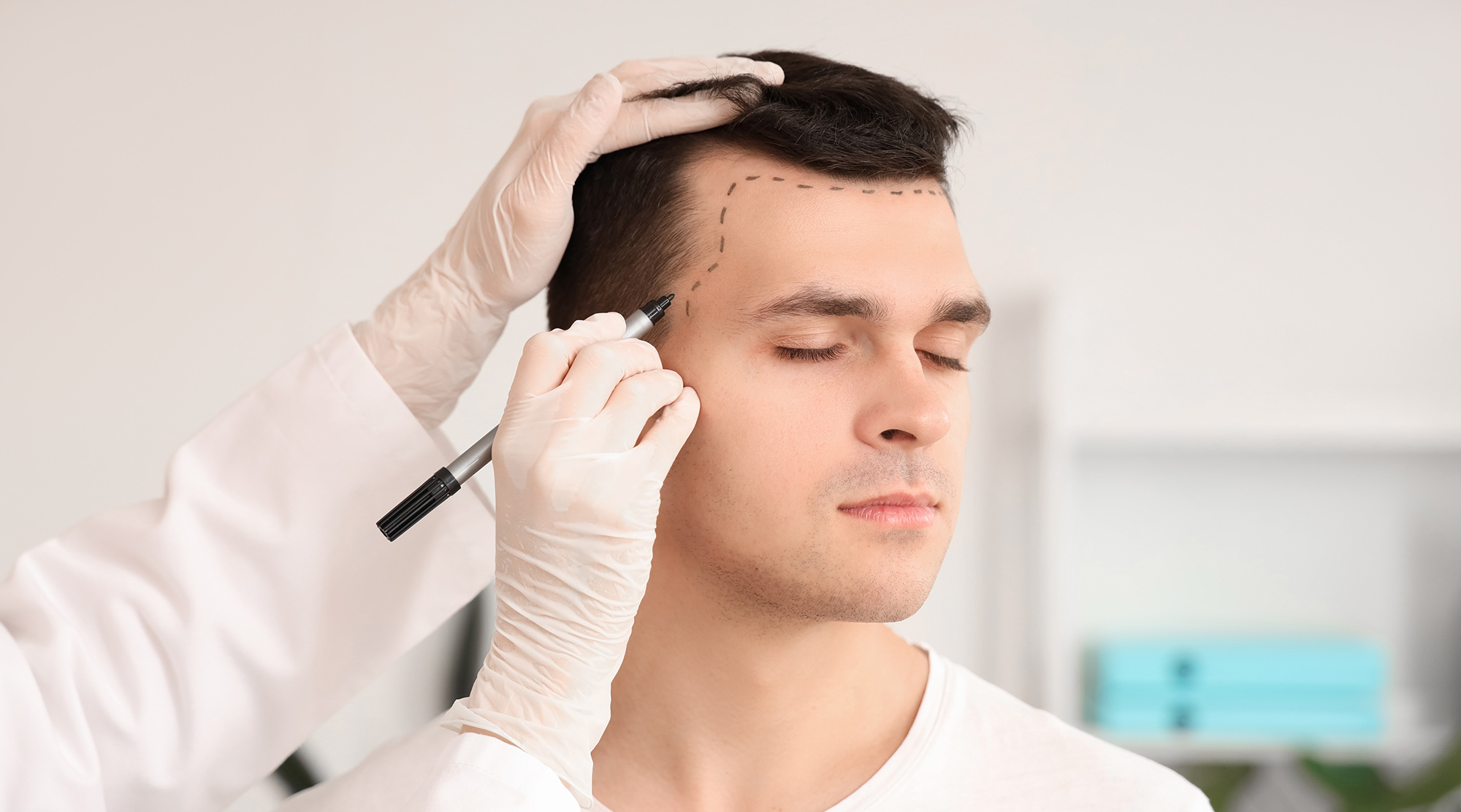 hair transplant clinic romford