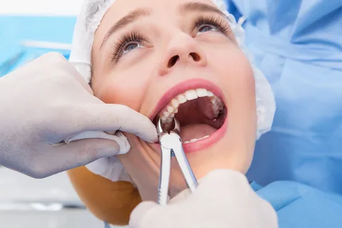 Tooth Extractions Alexandria