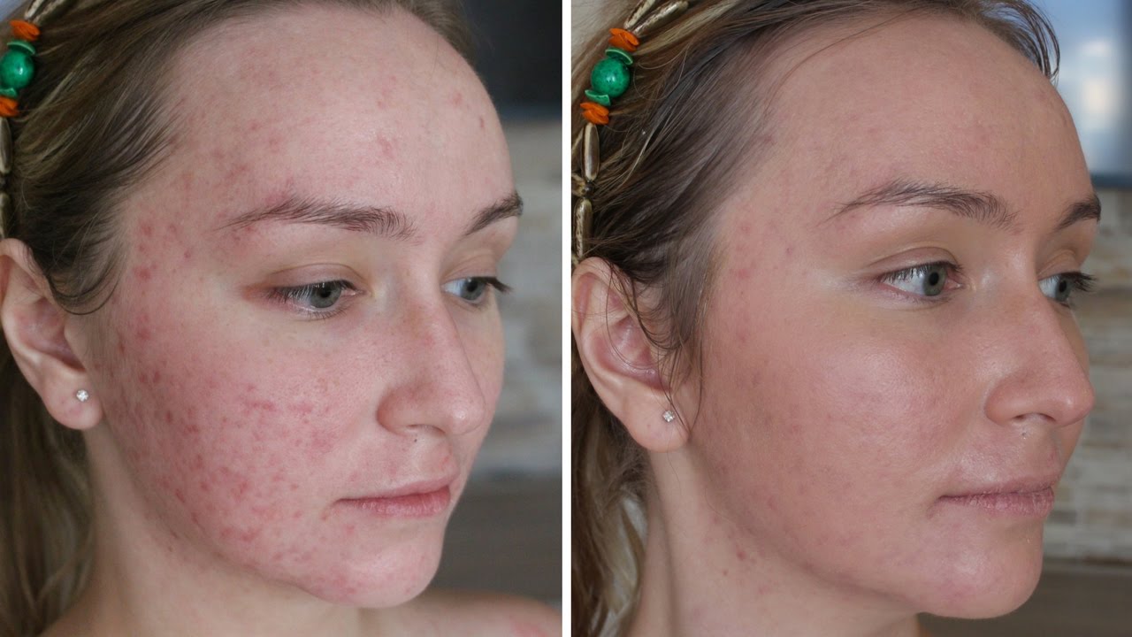 acne facials Georgetown, TX