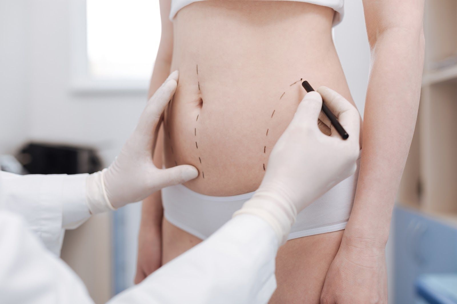 Liposuction