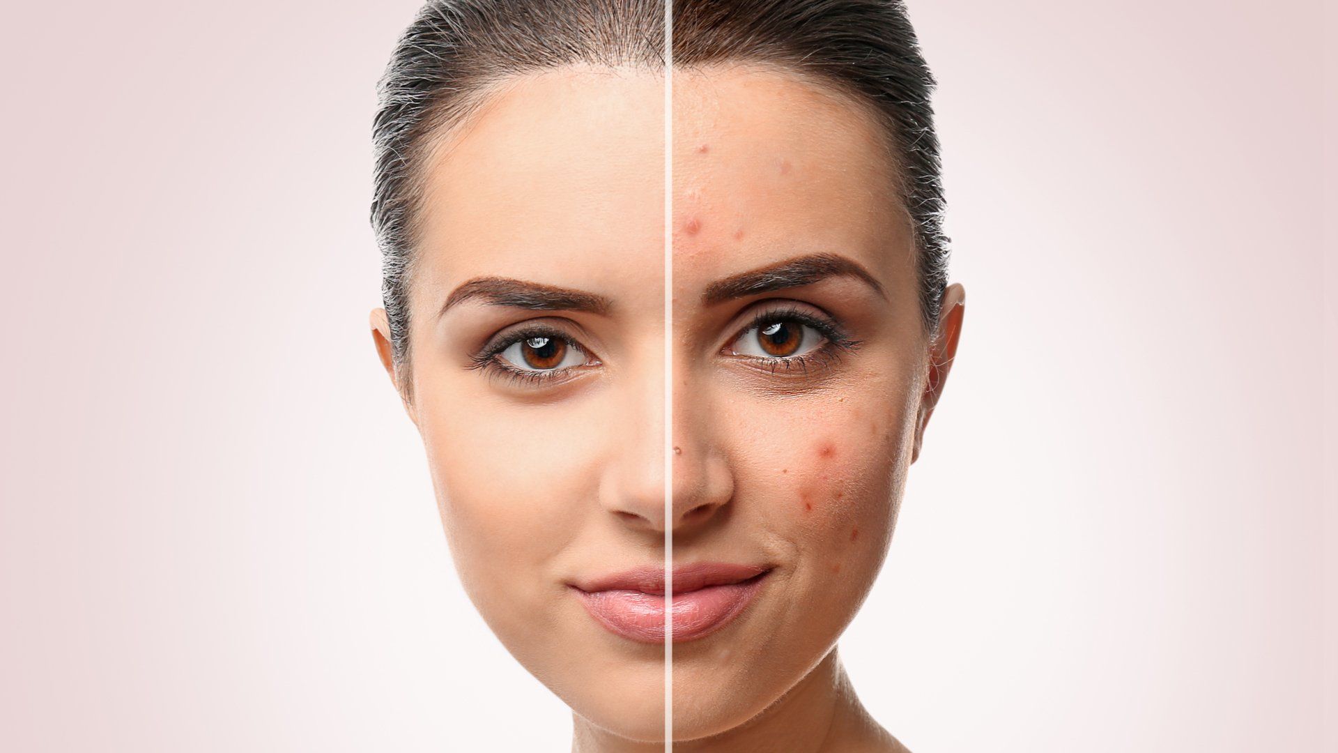 Rukhma Anti Acne Serum