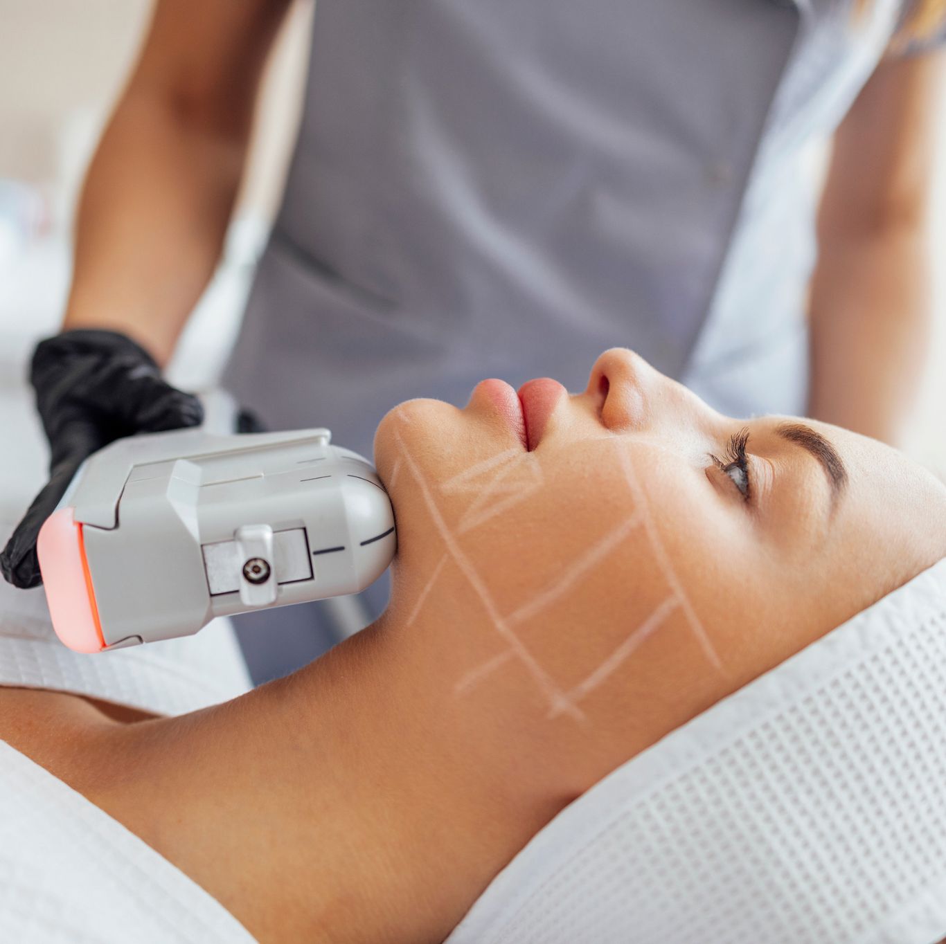 7D Hifu facial treatment