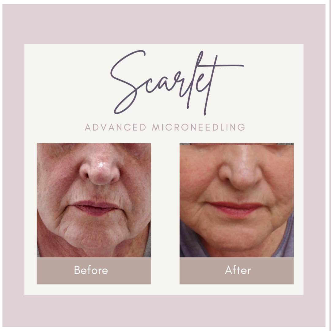 Lip Fillers