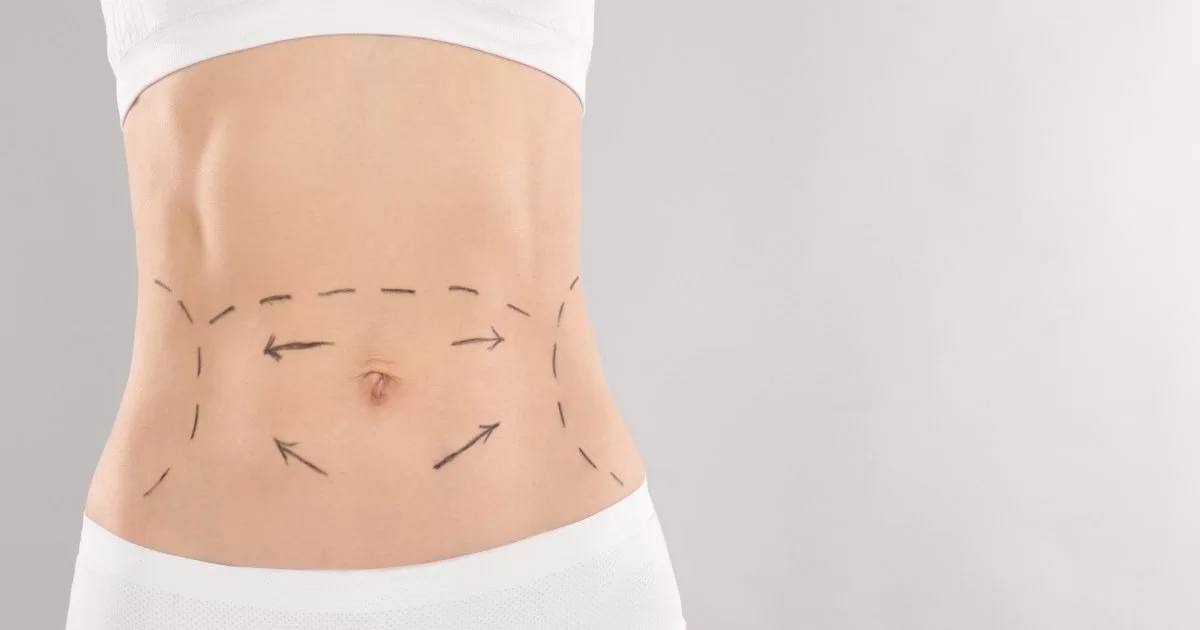 Fat Transfer Surgery in Dubai: Is It Right for You? Key Considerations Before the Procedure