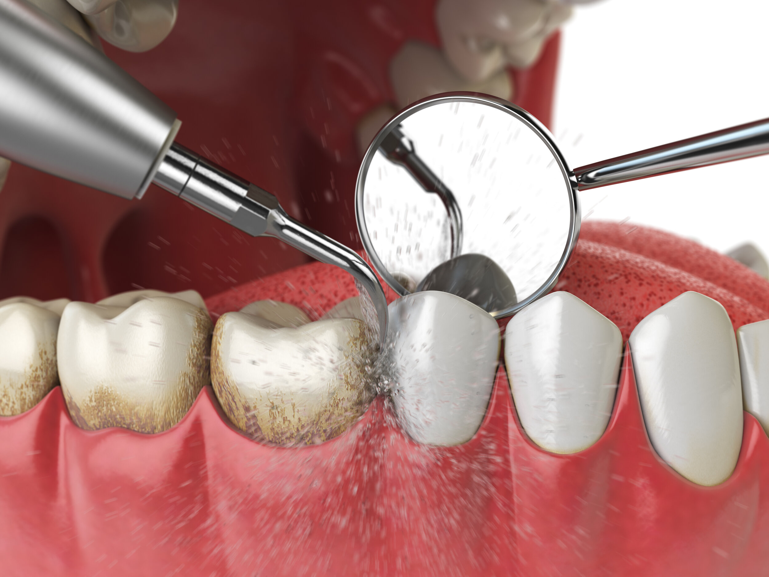 Professional,Teeth,Cleaning.,Ultrasonic,Teeth,Cleaning,Machine,Delete,Dental,Calculus