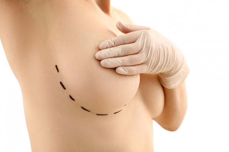 Exploring the Long-Term Effects of Breast Reduction Surgery