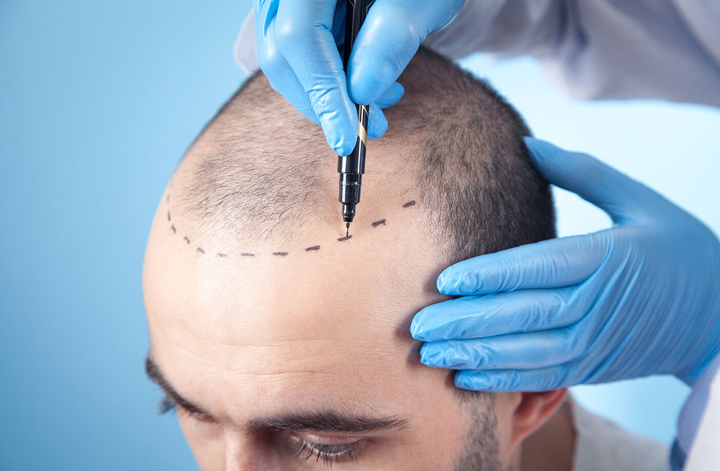 Hair Transplant in Dubai