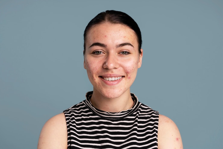 How Does Acne Treatment Work?