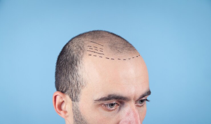 How Does Crown Hair Transplant Improve Hair?