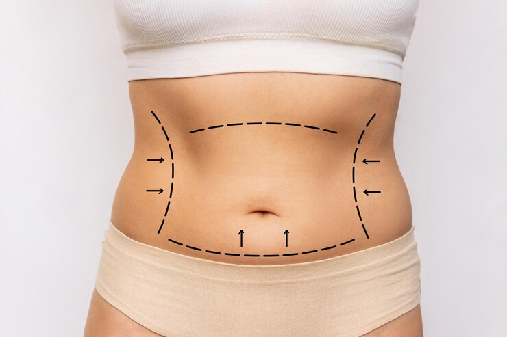 How Much Weight Can You Lose With Tummy Tuck Surgery